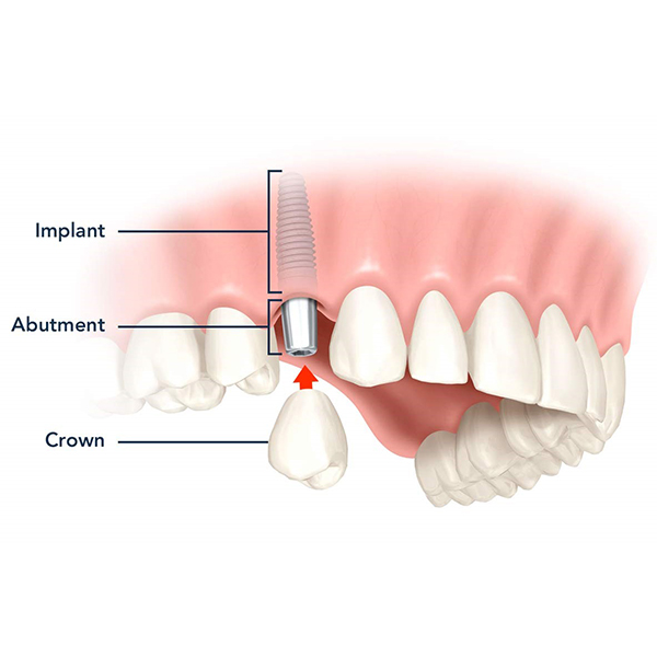Proper care improves longevity of dental implants