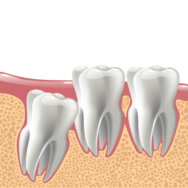 What you need to know about wisdom teeth?